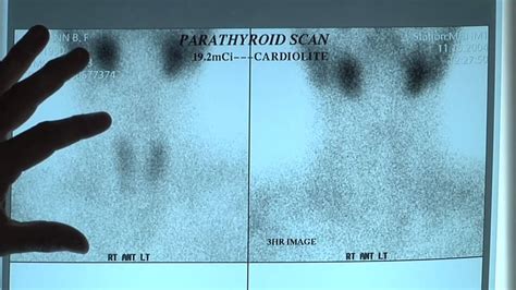 What are Sestamibi Scans? Positive & Negative Sestamibi Parathyroid Scans - YouTube