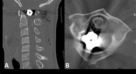 Cervical spinal cord bullet fragment removal using a minimally invasive surgical approach: a ...