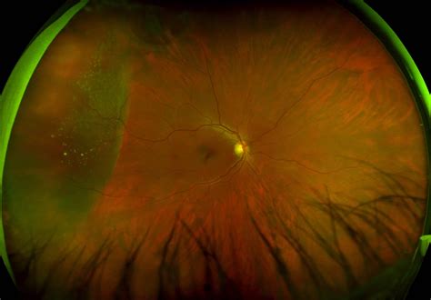 Clinic with optomap imaging cuts visits by a third - Insight