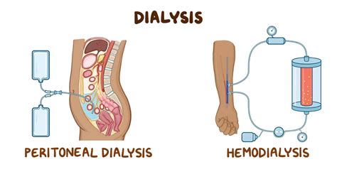 Dialysis care: Nursing - Osmosis Video Library