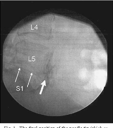 Figure 1 from A new technique for superior hypogastric plexus block: the posteromedian ...