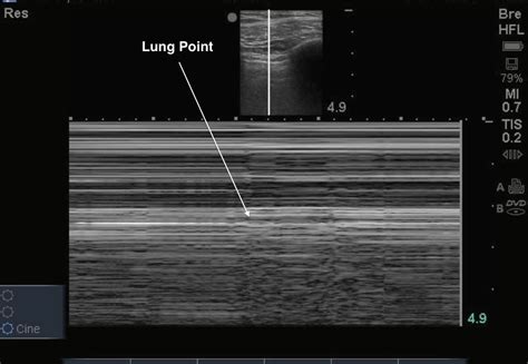 Lung Point Pneumothorax Ultrasound | SexiezPix Web Porn