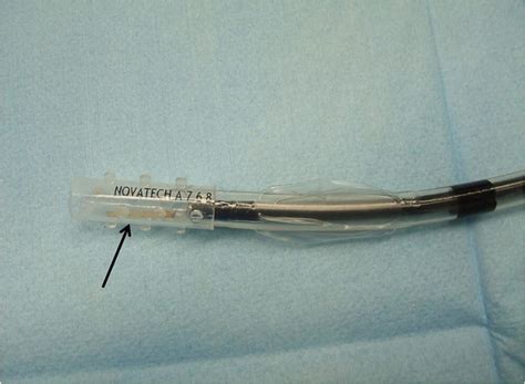 A GSS attached to the tip of an intubation tube. The arrow indicates ...