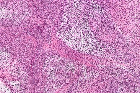 Malignant peripheral nerve sheath tumor pathophysiology - wikidoc