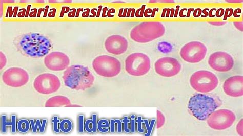 malaria parasite under microscope | P vivax malaria | malaria parasite blood smear - YouTube