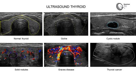 The Thyroid - Quantum Medical Imaging