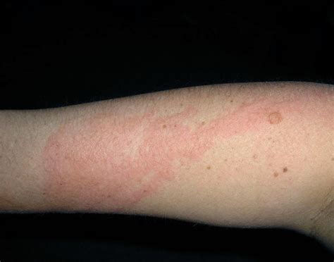 Poison Ivy Rash - Pictures, Treatment, Symptoms, Contagious, Duration