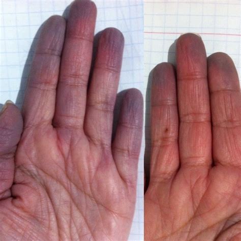 16 Things Only People With Raynaud's Will Understand | Raynauds, Raynaud's disease, Reynauds ...