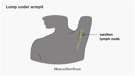 Bacterial Infection Armpit Lump