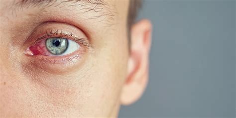 The most common eye infections