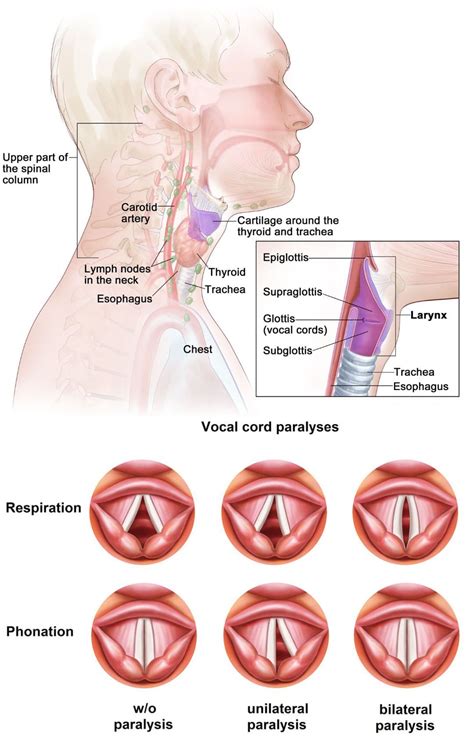 Vocal Cord Injury: El Paso's Chiropractic Injury Specialists