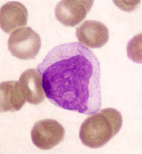 Blast cell with Auer rods | Medical Laboratories