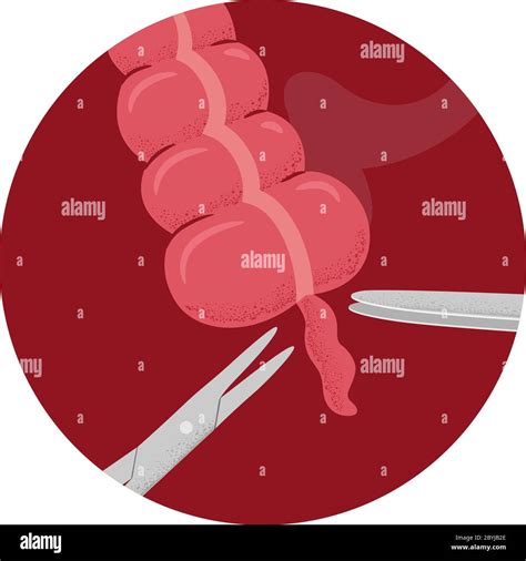 Illustration of Appendectomy Surgery Removing the Appendix With Appendicitis Through Scissors ...