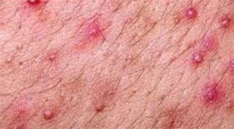 Rash on Groin, Sore, Painful, Red, Groin Rash Causes, Groin Heat Rash, Baby… | Groin rash, Heat ...