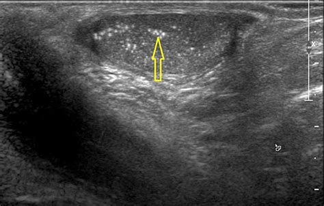 Unilateral testicular microlithiasis: a rare paediatric incidental ...