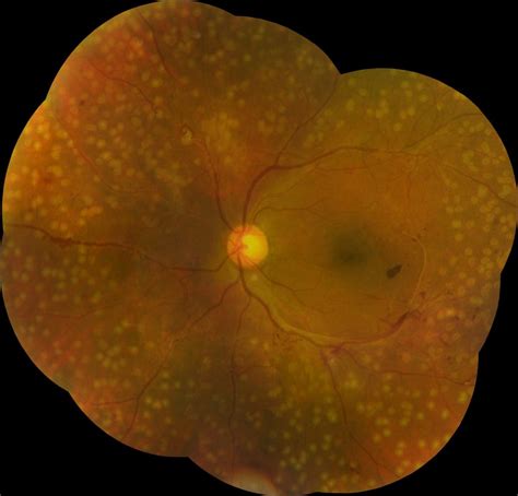 Laser for Diabetic Retinopathy - Dr Rehman Siddiqui