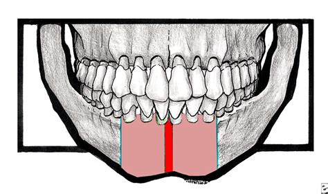 ORAL & MAXILLO-FACIAL SURGERY: Mandibular Symphyseal and Parasymphyseal Fractures