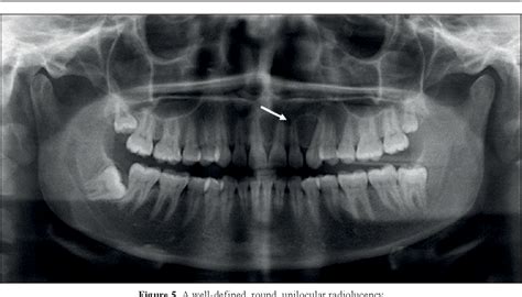 [PDF] Globulomaxillary cyst: does it still exist? A case report | Semantic Scholar