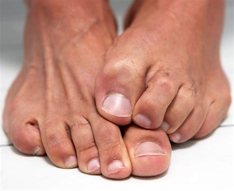 Non-Drug Treatments for Toenail Fungus - The New York Times