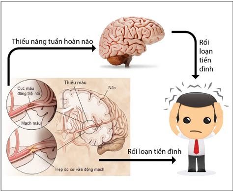 Chữa rối loạn tiền đình từ gốc - BẢO HUYẾT KHANG - giúp tăng tuần hoàn não và cải thiện rối loạn ...