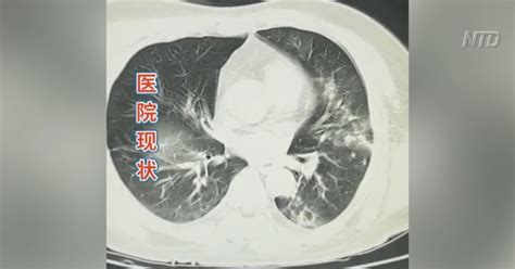 Children With ‘White Lung’ Symptoms Flood Chinese Hospitals; Concerns ...