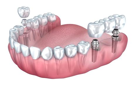 Dental Bridge vs Implant Cost | Dental Associates of Lodi