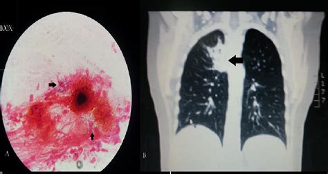 NOCARDIOSIS PULMONAR | Revista Médico Científica