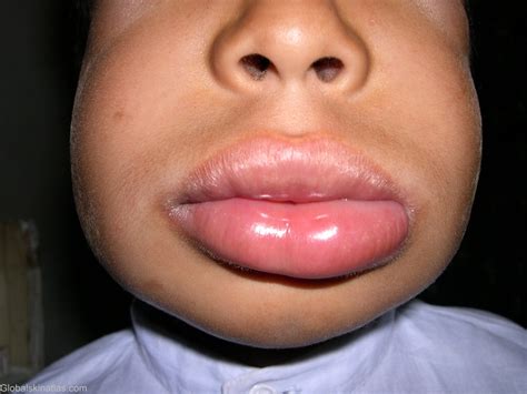 Angioedema – Core EM