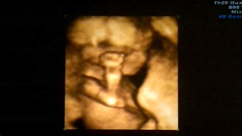 4d ultrasound pictures - ideasvirt