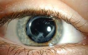 Corneal Scarring