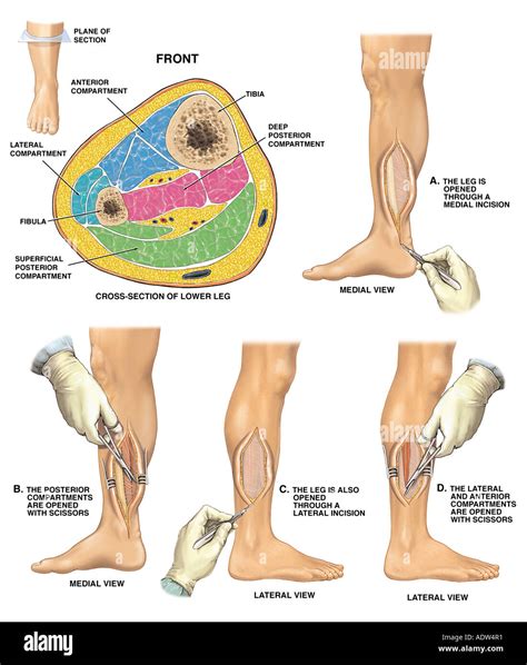 Compartments of leg fasciotomy - westparking