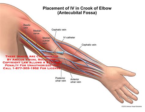 AMICUS Illustration of amicus,medical,arm,IV,placement,elbow,crook,antecubital,fossa,basilic ...