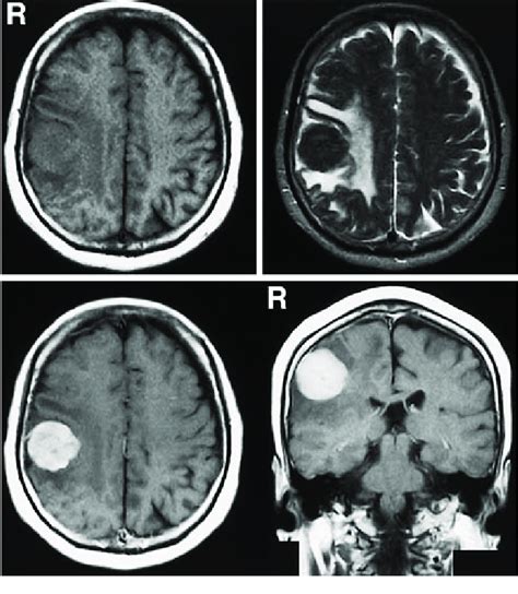 Magnetic resonance images showing a mass in the right frontal lobe as... | Download Scientific ...