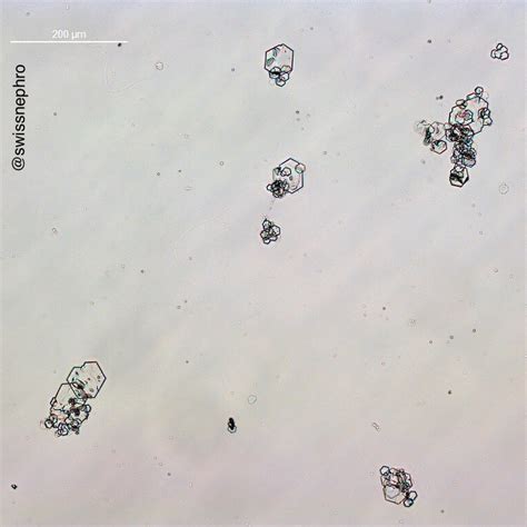 Urine Sediment of the Month: Cystine Crystals - Renal Fellow Network