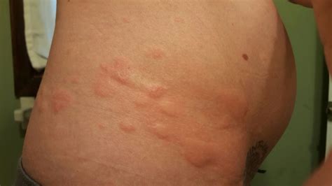 PUPPP rash??? - BabyCenter