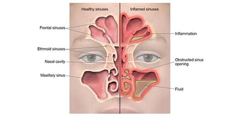 Sinuses Draining Blood - Best Drain Photos Primagem.Org