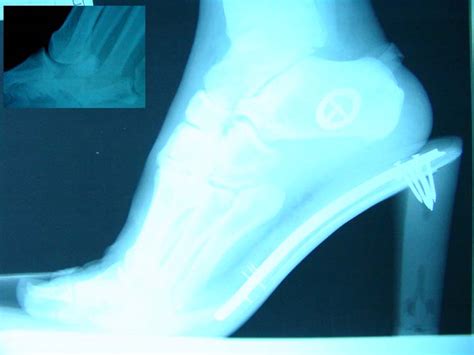 Tibial sesamoid fracture | The Foot and Ankle Online Journal