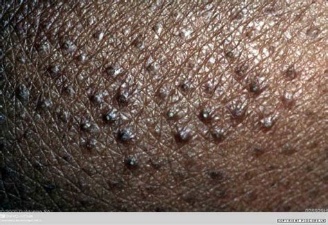 Lichen spinulosus | Primary Care Dermatology Society | UK