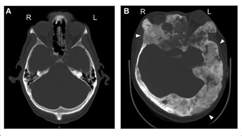 Fibrous Dysplasia Skull Bone Scan