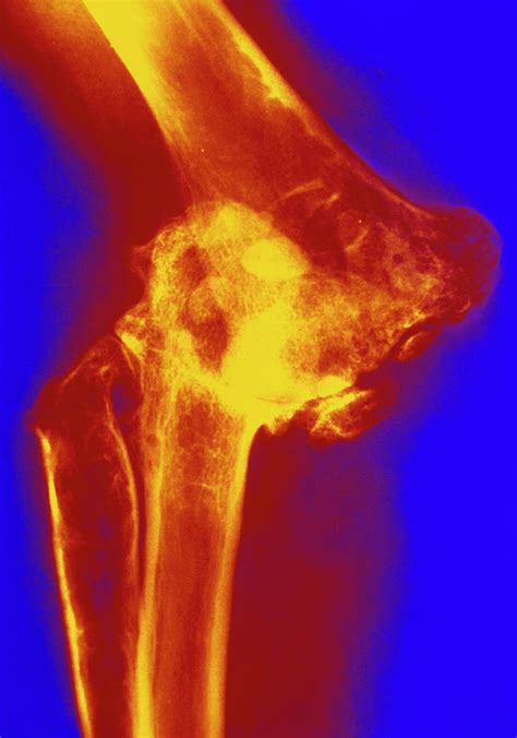 Col X-ray Of Rheumatoid Arthritis Of The Elbow Photograph by Medical ...