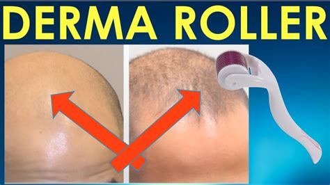 Dermaroller Before and After - Dermaroller before and after Results for Hair Growth - YouTube