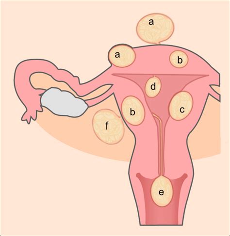 6 Types of Uterine Fibroids and Symptoms Explained - YouMeMindBody