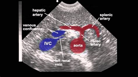 Abdominal Aorta Branches Abdominal Aorta Vascular Ultrasound Abdominal ...