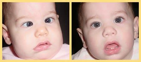 Medical Treatment Pictures-for Better Understanding: Strabismus Surgery: Before & After ...