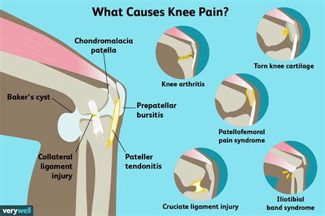 Outer Knee Pain Location Chart