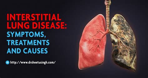 Interstitial Lung Disease: Symptoms, Treatments and Causes | Dr Sheetu