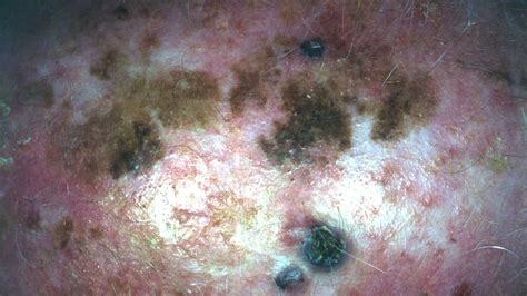 Lentigo Maligna Melanoma: Symptoms, Pictures, Treatment, and More