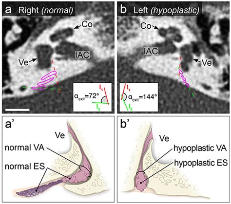 Frontiers | Radiological Configuration of the Vestibular Aqueduct Predicts Bilateral Progression ...