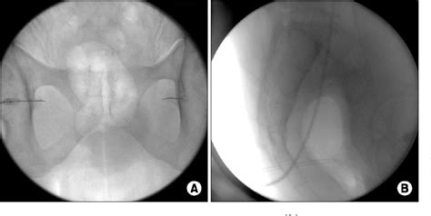 Figure 1 from Fluoroscopy-guided pudendal nerve block and pulsed ...