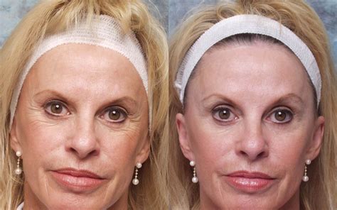 Face Exercises For Regaining A More Youthful Look | Botox ...